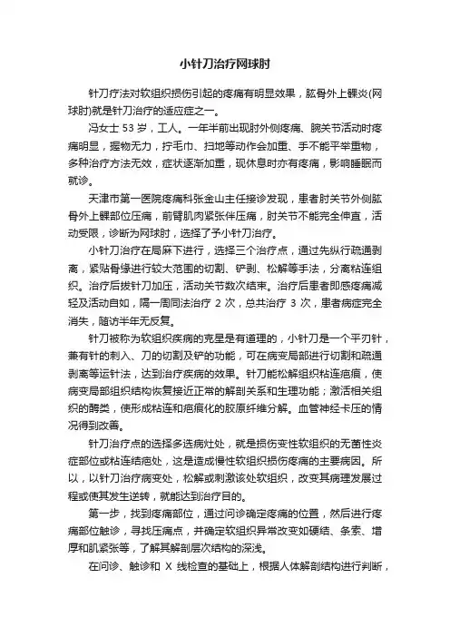 小针刀治疗网球肘