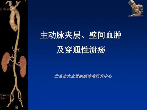 主动脉夹层、壁间血肿及穿通性溃疡