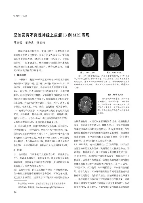 胚胎发育不良性神经上皮瘤13例MRI表现