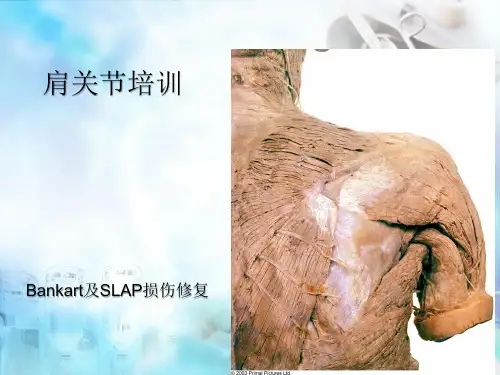 (医学课件)肩关节 bankart 损伤