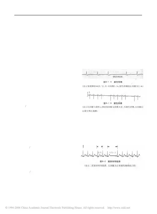 临床实用心电图入门  第八讲  病态窦房结综合征