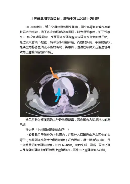 上腔静脉阻塞综合征，肺癌中常见又棘手的问题