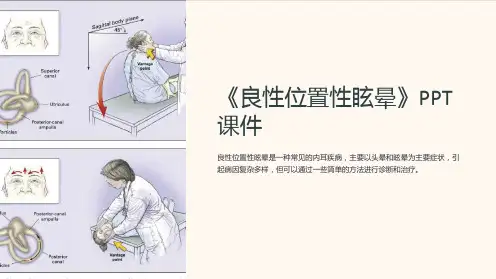 《良性位置性眩晕》课件