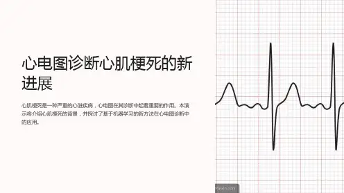 心电图诊断心肌梗死的新进展