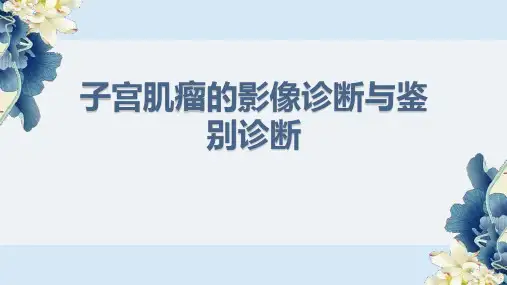 子宫肌瘤的影像诊断与鉴别诊断