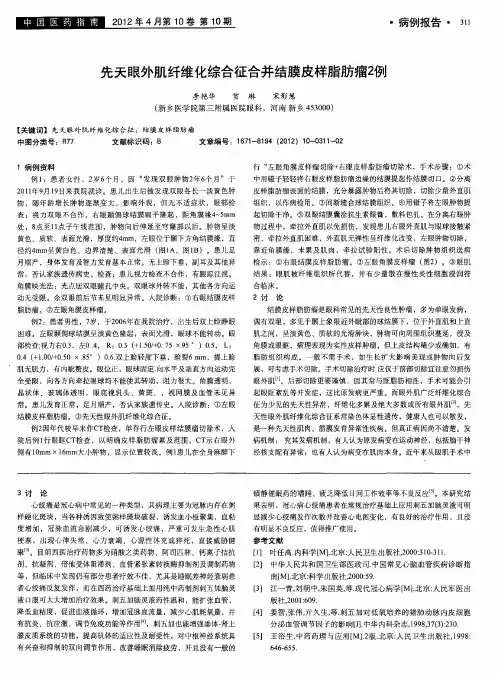 先天眼外肌纤维化综合征合并结膜皮样脂肪瘤2例