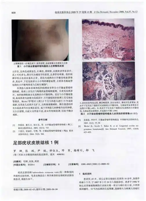 足部疣状皮肤结核1例