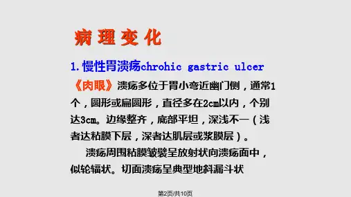 病理生理学消化性溃疡.pptx