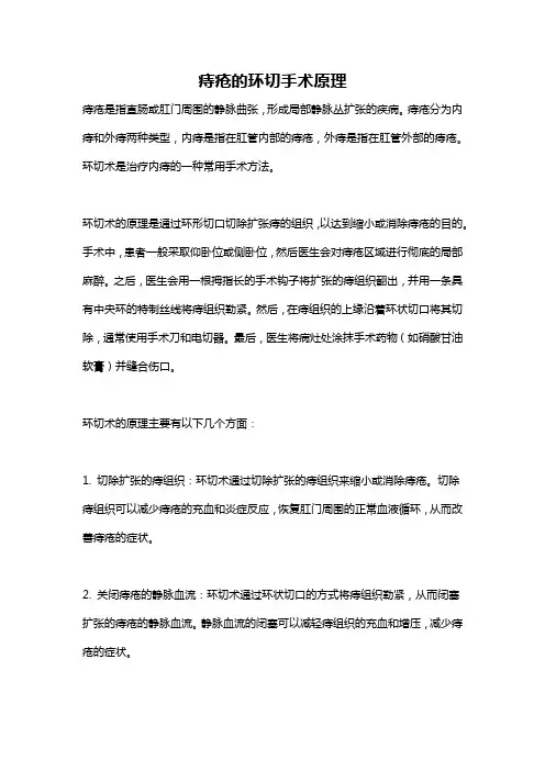 痔疮的环切手术原理