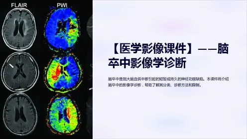 【医学影像课件】-脑卒中影像学诊断