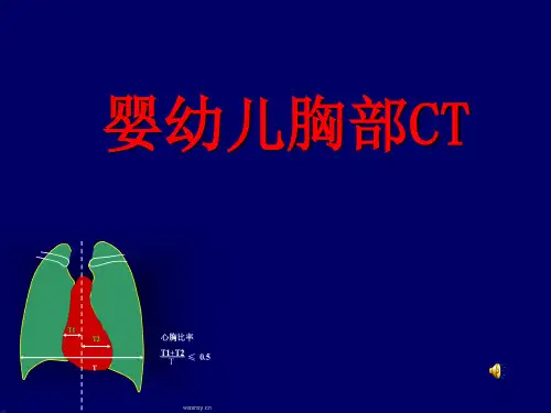 儿童胸部CT