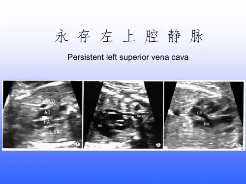 永存左上腔静脉ppt课件