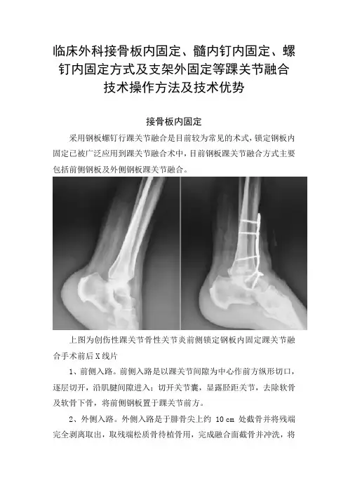 临床外科接骨板内固定、髓内钉内固定、螺钉内固定方式及支架外固定等踝关节融合技术操作方法及技术优势