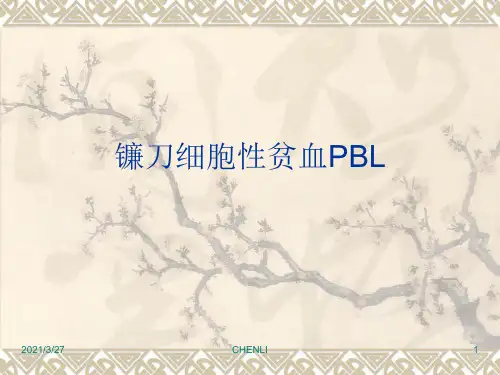 镰刀型细胞贫血症