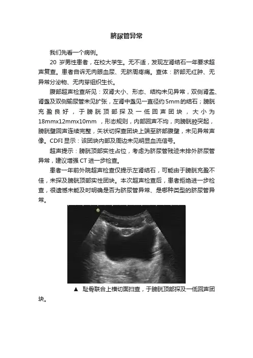 脐尿管异常