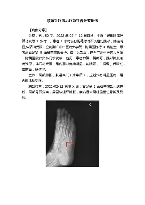 岐黄针疗法治疗急性踝关节扭伤