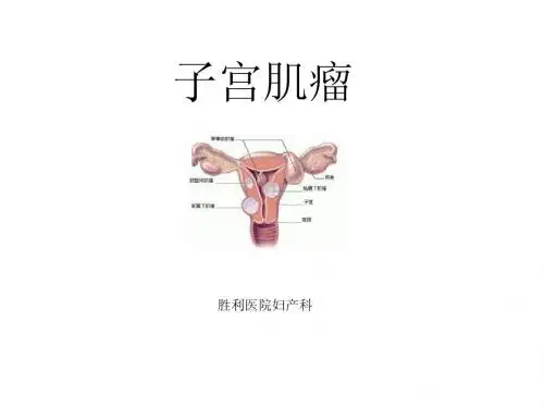 子宫肌瘤