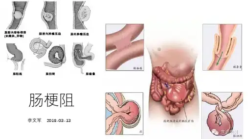 肠梗阻