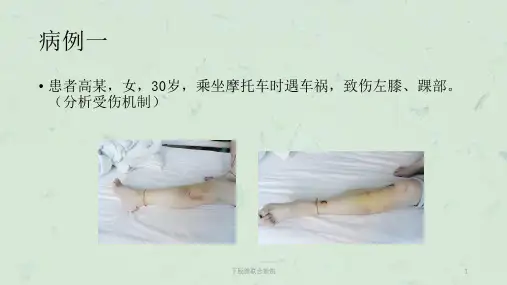 下胫腓联合损伤课件
