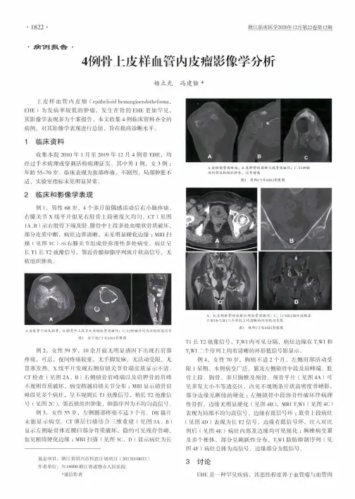 4例骨上皮样血管内皮瘤影像学分析