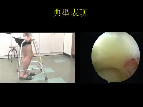 医学ppt--半月板损伤的关节镜技术中文