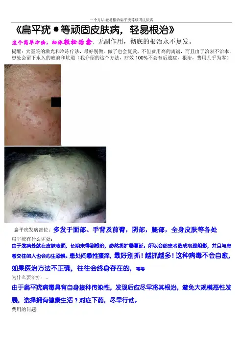 一个方法,轻易根治扁平疣等顽固皮肤病