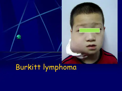 2008-恶性淋巴瘤-BL- 病理学课件