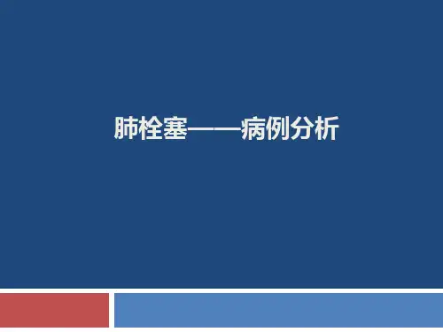 肺栓塞病例分析完整版本