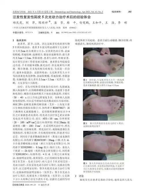 泛发性复发性跖疣5次光动力治疗术后的经验体会