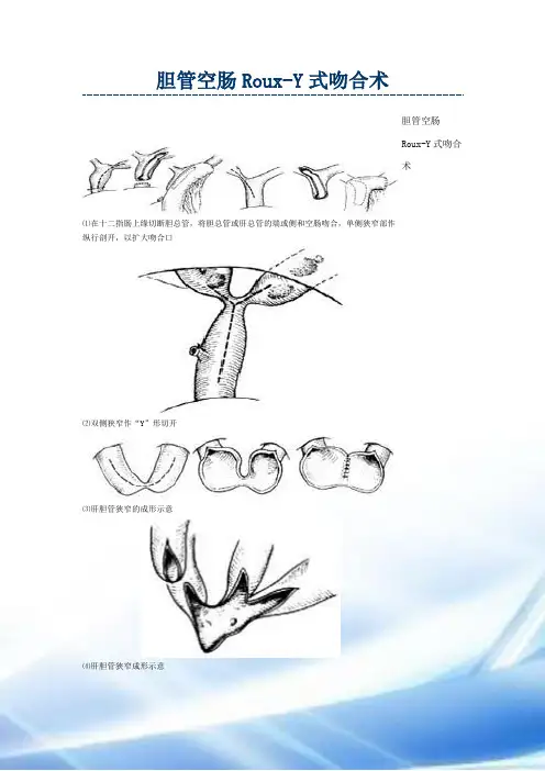 胆管空肠Roux-Y式吻合术