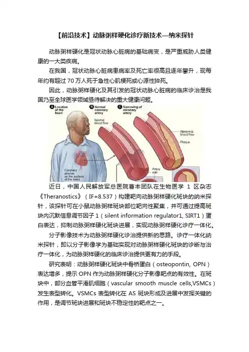 【前沿技术】动脉粥样硬化诊疗新技术—纳米探针