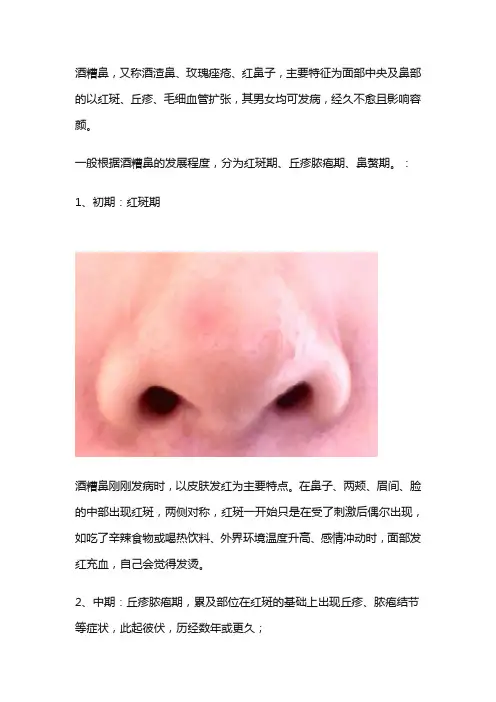 玫瑰痤疮(酒糟鼻)常见的疗法