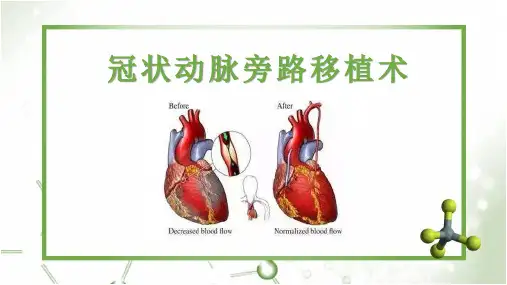 冠状动脉旁路搭桥术