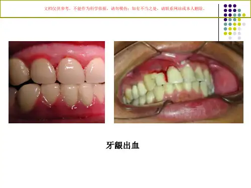 牙周疾病专题培训培训课件