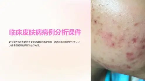 临床皮肤病病例分析课件
