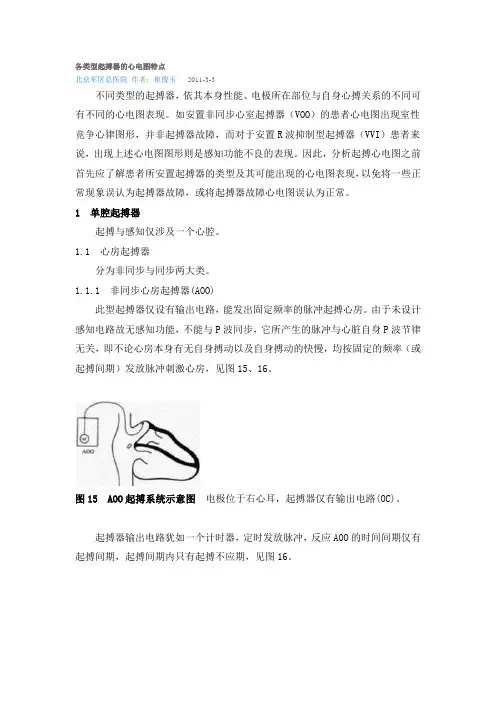 各类型起搏器的心电图特点