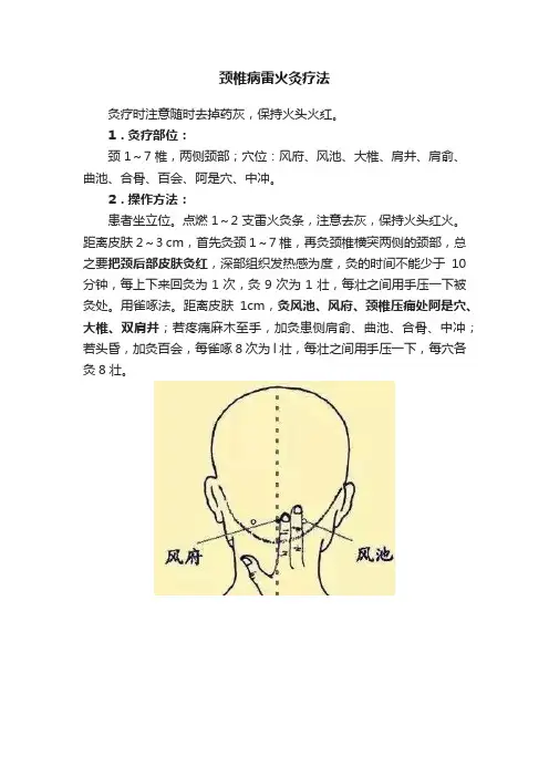 颈椎病雷火灸疗法