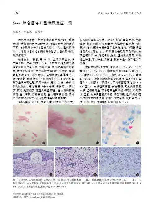 Sweet综合征样II型麻风反应一例