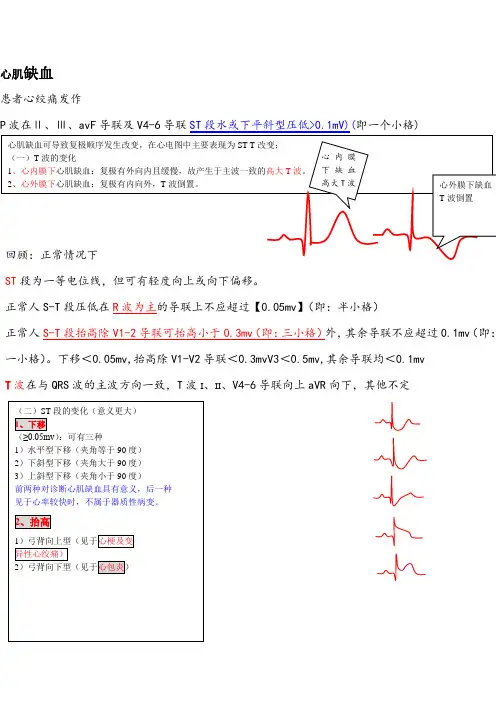 心肌缺血与梗死 心电图分析
