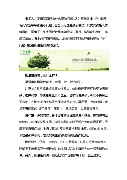 脂溢性皮炎初期症状表现及抹什么好一些？