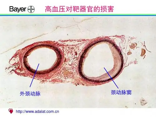 2019年高血压对靶器官的损害(图谱).ppt