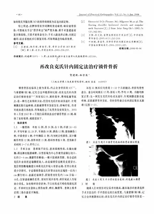 再改良克氏针内固定法治疗锁骨骨折