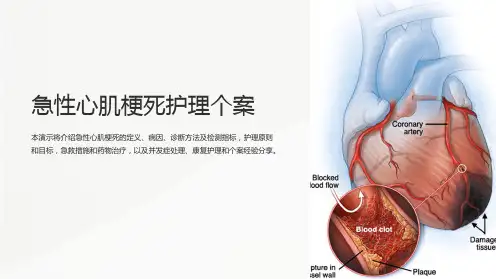 急性心肌梗死护理个案
