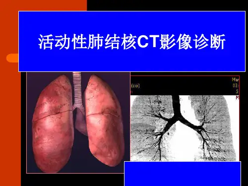 活动性肺结核影像诊断
