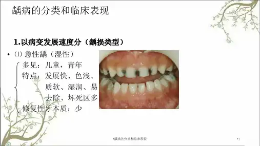龋病的分类和临床表现课件