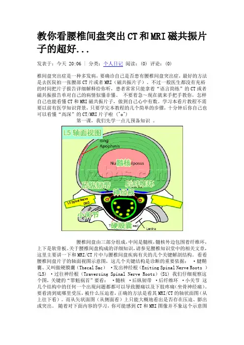 教你看腰椎间盘突出CT和MRI磁共振片子的超好