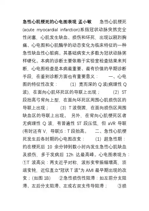 急性心梗心电图表现