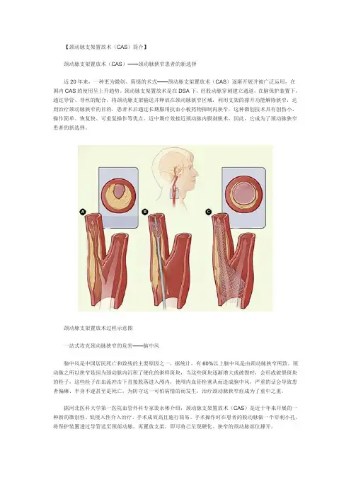 颈动脉支架置放术(CAS)简介