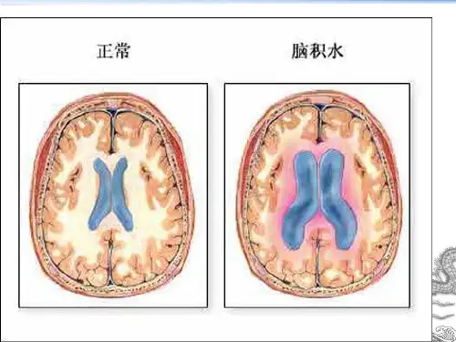 脑积水脑室腹腔分流术的护理
