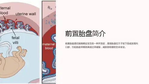 前置胎盘病例讨论课件